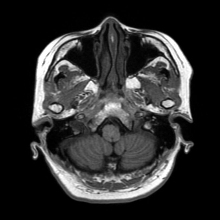 Anti-MOG encephalomyelitis (Radiopaedia 73831-84646 Axial T1 9).jpg