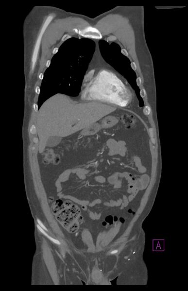 File:Aortectomy and axillary-bifemoral bypass (Radiopaedia 28303-28545 C 26).jpg