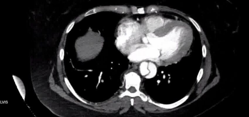Aortic Dissection (Radiopaedia 85272-100847 A 31).jpg