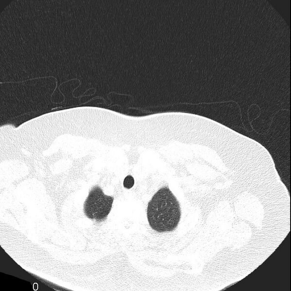 File:Aortic arch false aneurysm (Radiopaedia 14667-14587 Axial lung window 1).jpg