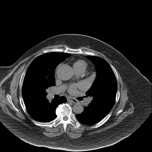 File:Aortic arch false aneurysm (Radiopaedia 14667-14587 Axial non-contrast 25).jpg