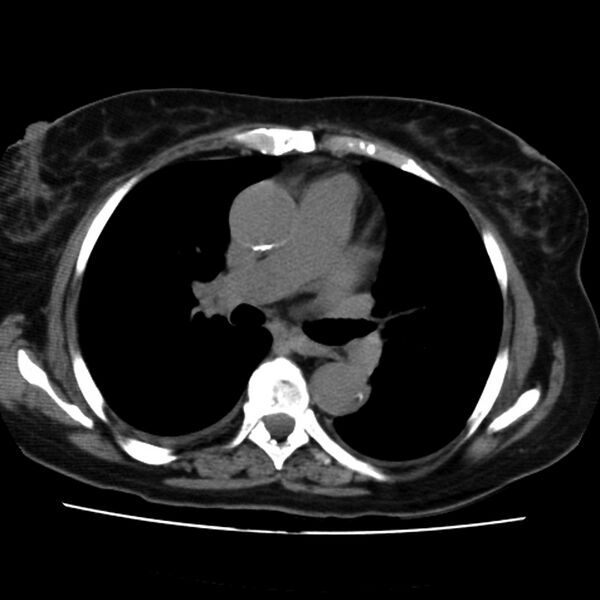 File:Aortic arch pseudoaneurysm (Radiopaedia 8534-9368 Axial non-contrast 35).jpg