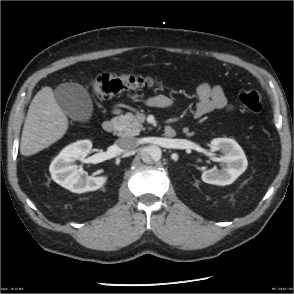 File:Aortic dissection- Stanford A (Radiopaedia 37759-39664 A 91).jpg
