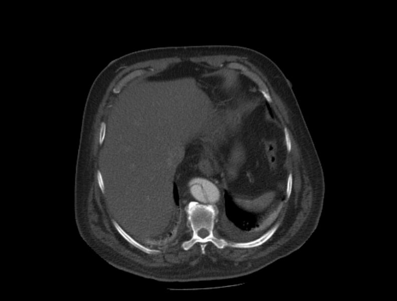File:Aortic dissection (Radiopaedia 28802-29105 A 35).jpg