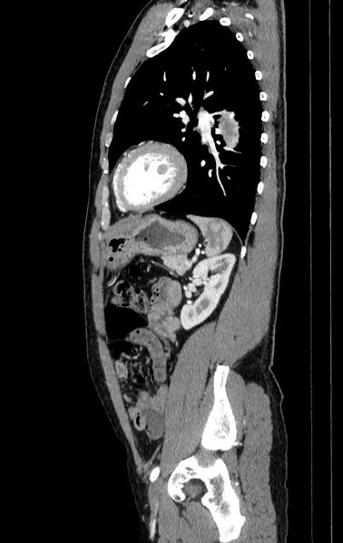 File:Aortic dissection - Stanford type A (Radiopaedia 83418-98500 B 71).jpg