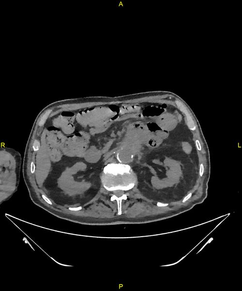 File:Aortoenteric fistula (Radiopaedia 84308-99603 Axial non-contrast 119).jpg