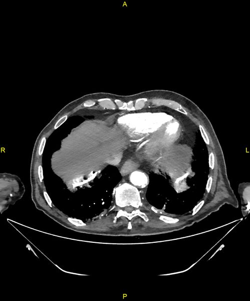 File:Aortoenteric fistula (Radiopaedia 84308-99603 B 15).jpg