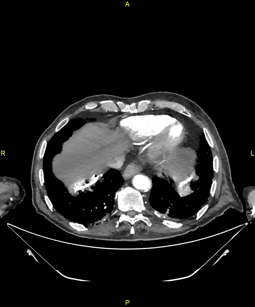 Aortoenteric fistula (Radiopaedia 84308-99603 B 15).jpg