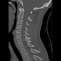Apical pneumothorax on cervical spine CT (Radiopaedia 45343-49368 Sagittal bone window 16).jpg