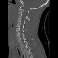 Apical pneumothorax on cervical spine CT (Radiopaedia 45343-49368 Sagittal bone window 21).jpg