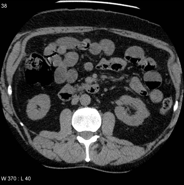 File:Appendicitis (Radiopaedia 12510-12733 Axial non-contrast 5).jpg