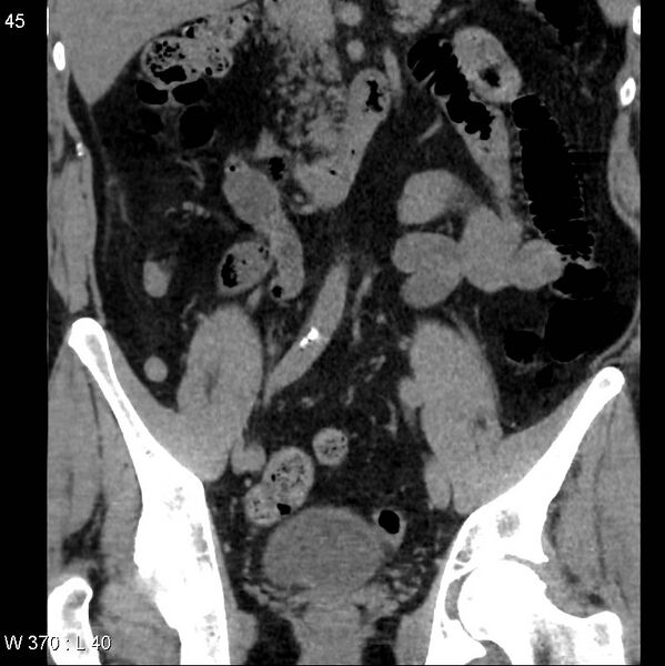 File:Appendicitis (Radiopaedia 12510-12733 Coronal non-contrast 15).jpg