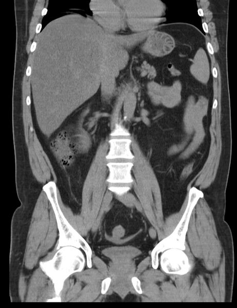 File:Appendicitis and giant appendicolith (Radiopaedia 80251-93588 Coronal non-contrast 25).jpg