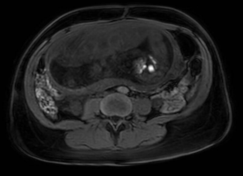 File:Appendicitis in gravida (MRI) (Radiopaedia 89433-106395 Axial DIXON 79).jpg