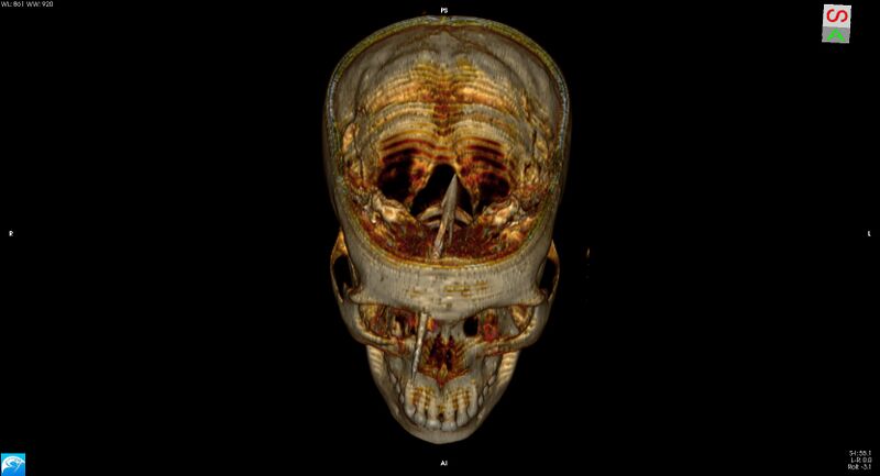 File:Arrow injury to the brain (Radiopaedia 72101-82607 3D bone 14).jpg