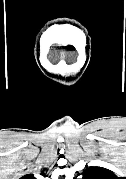 File:Arrow injury to the brain (Radiopaedia 72101-82607 Coronal non-contrast 69).jpg