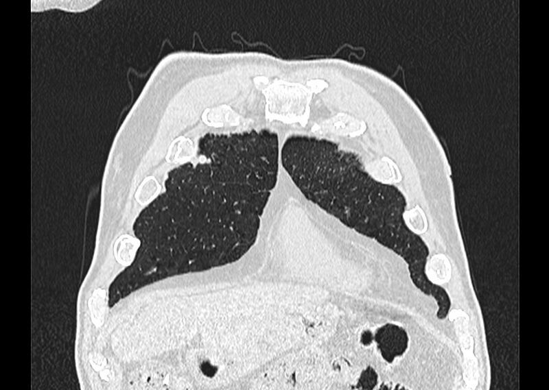 File:Asbestos pleural placques (Radiopaedia 57905-64872 Coronal lung window 30).jpg