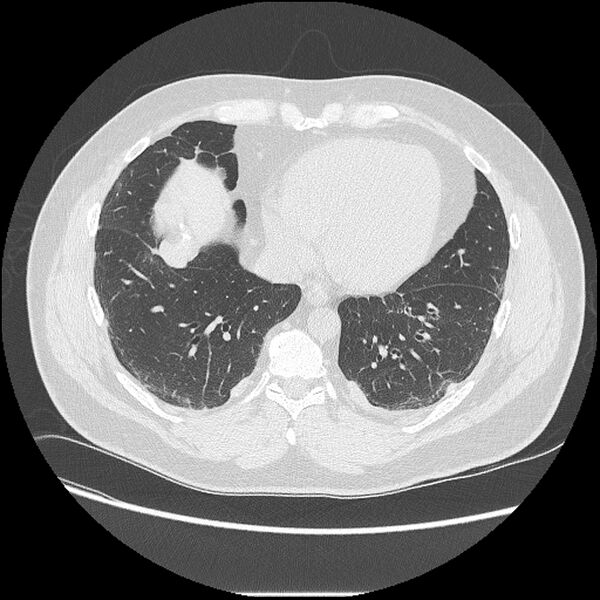 File:Asbestosis (Radiopaedia 45002-48961 Axial lung window 35).jpg