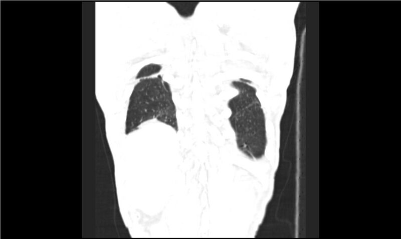 File:Aspergilloma (Radiopaedia 20788-20701 Coronal lung window 17).jpg