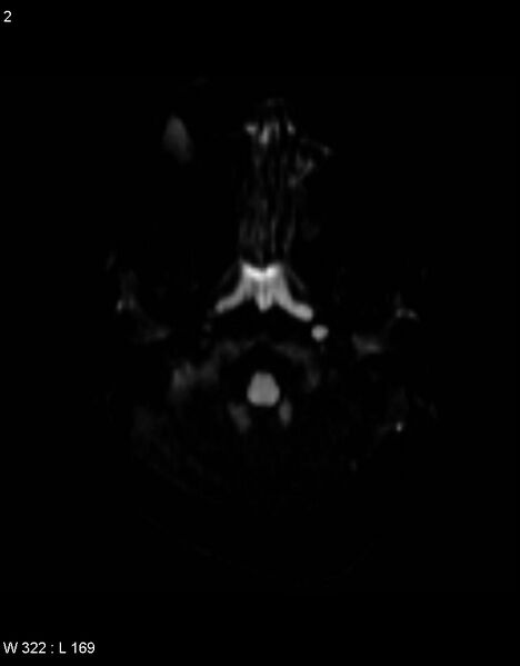 File:Astroblastoma (Radiopaedia 39792-42217 Axial DWI 1).jpg