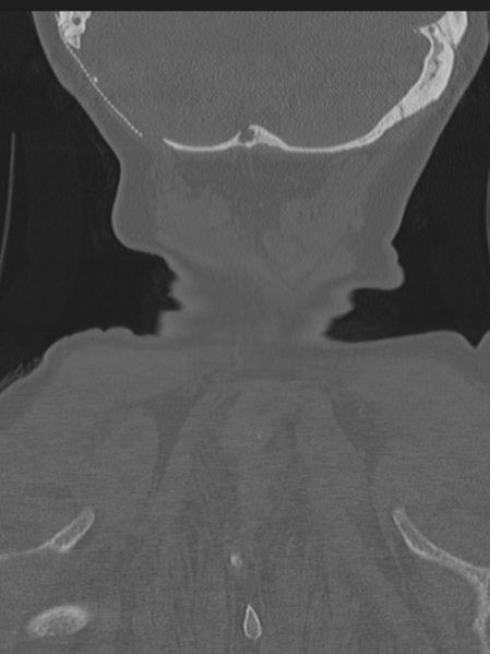 File:Atlanto-axial subluxation (Radiopaedia 36610-38176 Coronal bone window 50).png