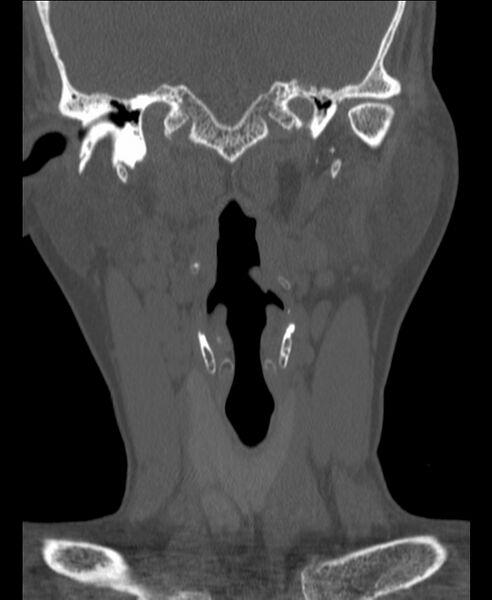File:Atlanto-occipital assimilation with basilar invagination (Radiopaedia 70122-80188 Coronal bone window 25).jpg