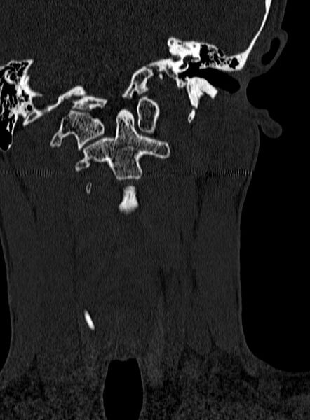 File:Atlantoaxial subluxation (Radiopaedia 44681-48450 Coronal bone window 17).jpg