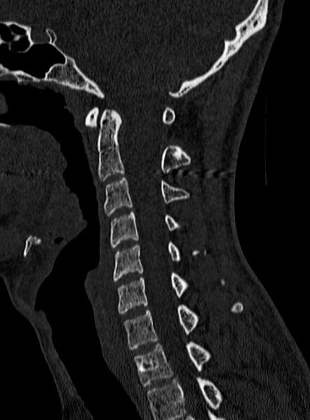 File:Atlantoaxial subluxation (Radiopaedia 44681-48450 Sagittal bone window 66).jpg