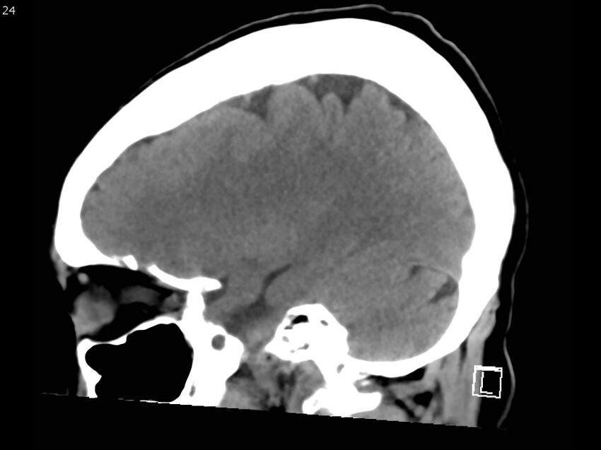 Atypical meningioma - intraosseous (Radiopaedia 64915-73867 C 22).jpg