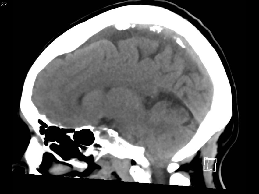 Atypical meningioma - intraosseous (Radiopaedia 64915-73867 C 35).jpg