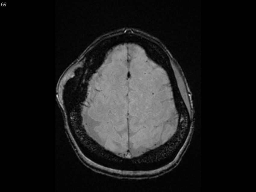 Atypical meningioma - intraosseous (Radiopaedia 64915-74572 Axial SWI 69).jpg