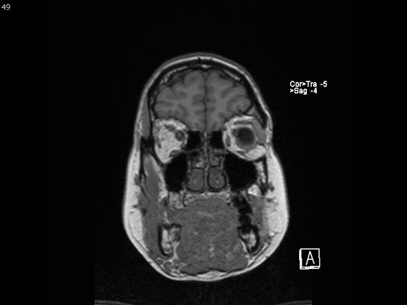 File:Atypical meningioma - intraosseous (Radiopaedia 64915-74572 Coronal T1 49).jpg