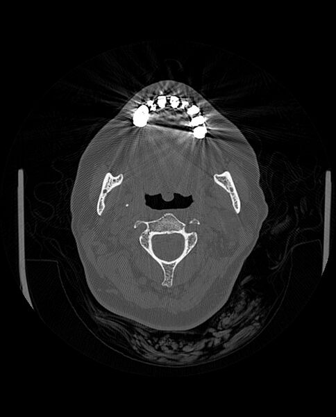 File:Automastoidectomy with labyrinthine fistula (Radiopaedia 84143-99411 Axial non-contrast 11).jpg