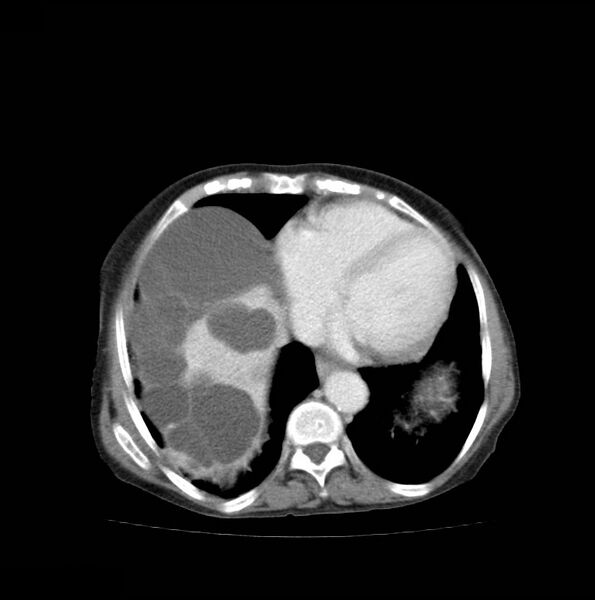 File:Autosomal dominant polycystic kidney disease (Radiopaedia 16777-16490 A 6).jpg