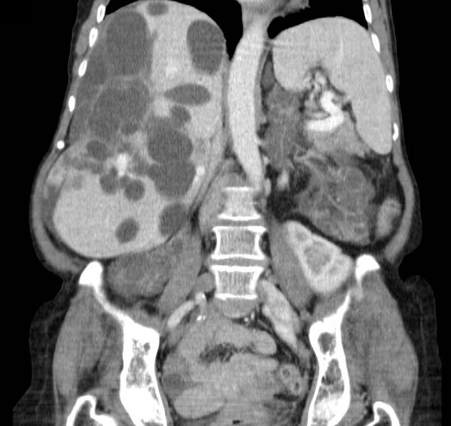 File:Autosomal dominant polycystic kidney disease (Radiopaedia 16777-16490 B 28).jpg