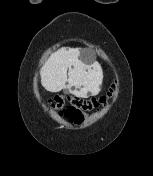 File:Autosomal dominant polycystic kidney disease (Radiopaedia 57124-64017 B 5).jpg
