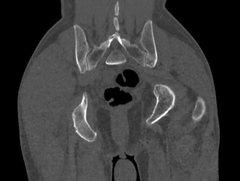 File:Avascular necrosis of the left hip (Radiopaedia 75068-86125 Coronal bone window 85).jpg