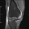 Avulsion fracture of the fibular head (Radiopaedia 74804-85808 Coronal PD fat sat 14).jpg