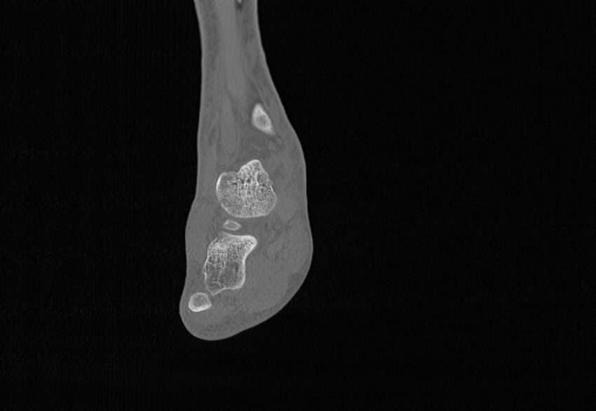 Avulsion fractures of talus and calcaneus (Radiopaedia 48277-53155 Coronal bone window 45).jpg