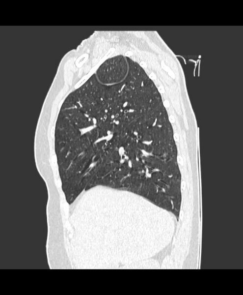 File:Azygos fissure and azygos lobe (Radiopaedia 41841-44832 Sagittal lung window 3).jpg