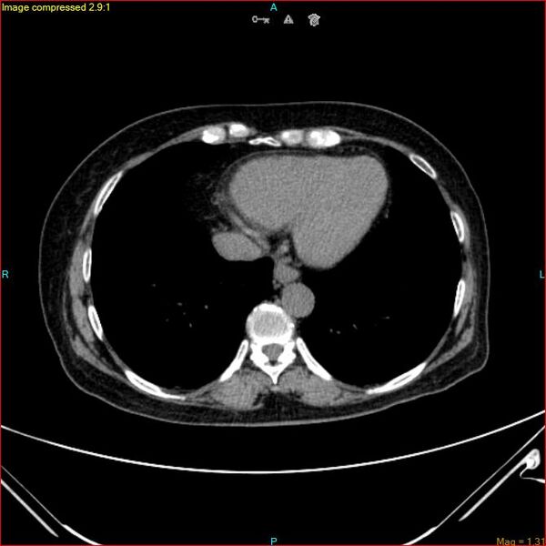 File:Azygos vein aneurysm (Radiopaedia 77824-90130 A 42).jpg