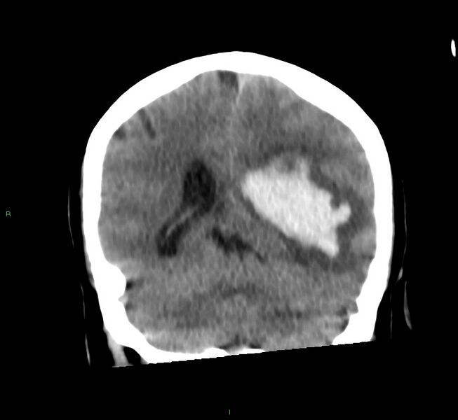 File:Basal ganglia hemorrhage (Radiopaedia 58759-65981 Coronal non-contrast 29).jpg