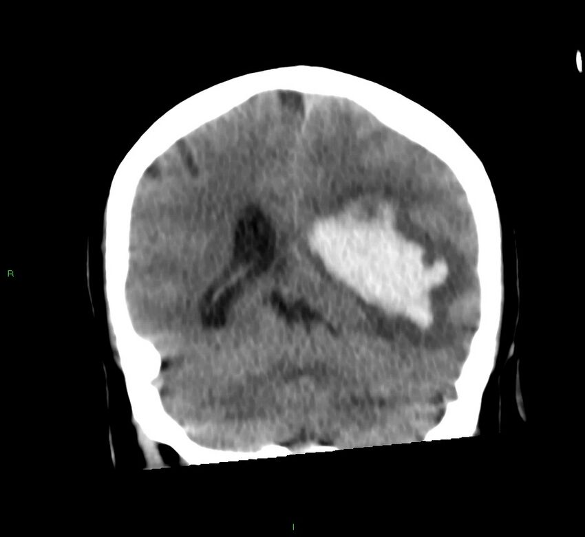 Basal ganglia hemorrhage (Radiopaedia 58759-65981 Coronal non-contrast 29).jpg