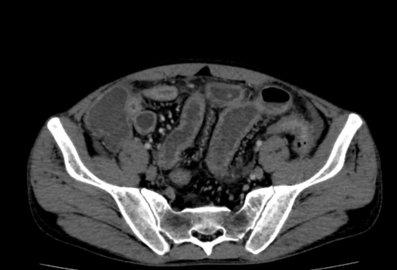 File:Behçet's disease- abdominal vasculitis (Radiopaedia 55955-62570 A 70).jpg