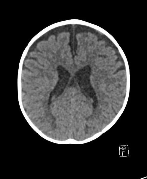 File:Benign enlargement of subarachnoid spaces in infancy (BESS) (Radiopaedia 87459-103795 Axial non-contrast 36).jpg