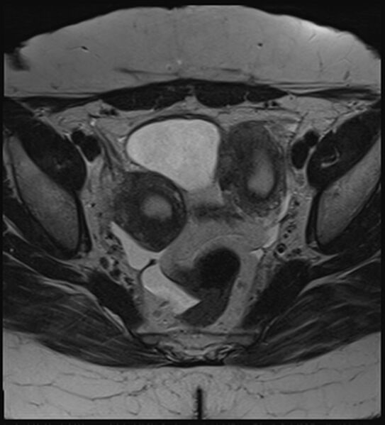 File:Bicornuate, unicollis uterus (Radiopaedia 79468-92593 Axial T2 10).jpg