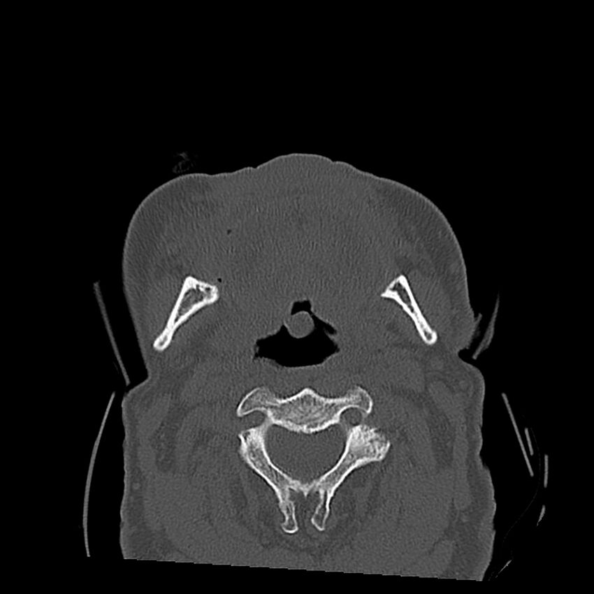 Bilateral Le Fort fractures (Radiopaedia 32192-33135 Axial bone window 22).jpg