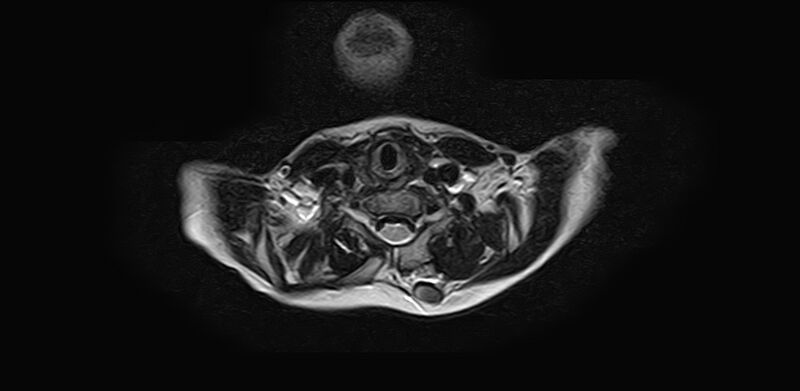 File:Bilateral Sprengel deformity with Klippel-Feil syndrome (Radiopaedia 66395-75650 Axial T2 15).jpg
