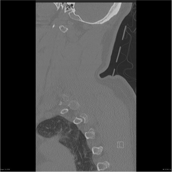 File:Bilateral cervical ribs (Radiopaedia 25868-26017 Sagittal bone window 11).jpg