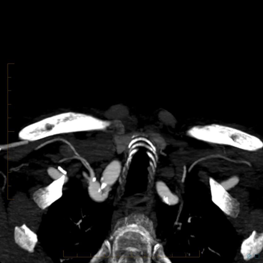 Bilateral chronic common carotid occlusion (Radiopaedia 50849-56362 D 53).jpg